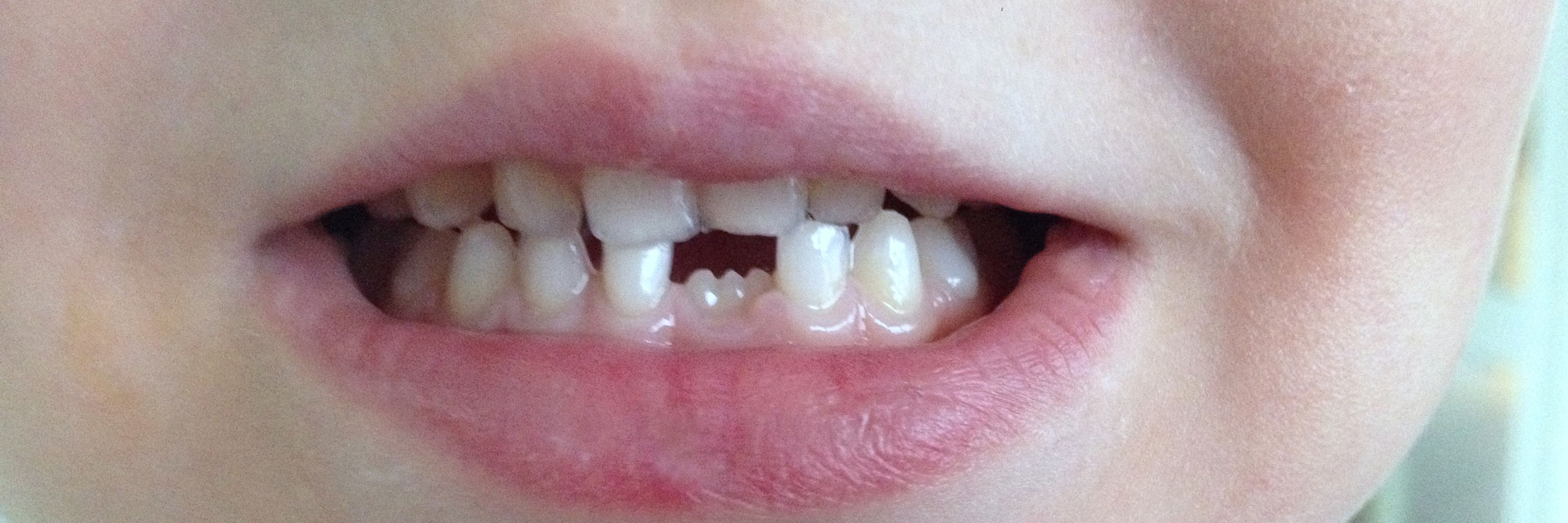 Tandsæt med ny fortand på vej